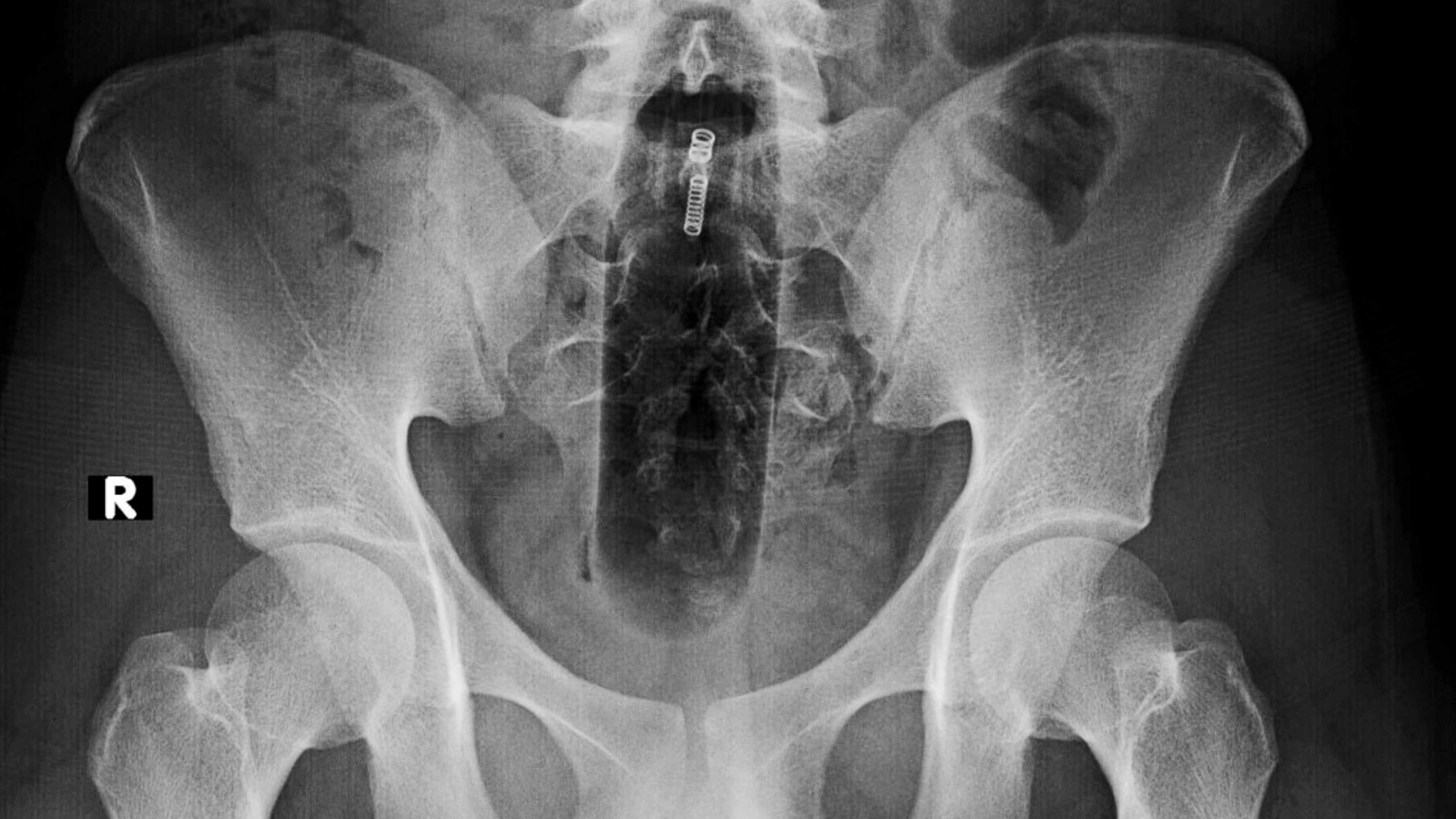 Worst things that got stuck up people’s butts last year revealed by government