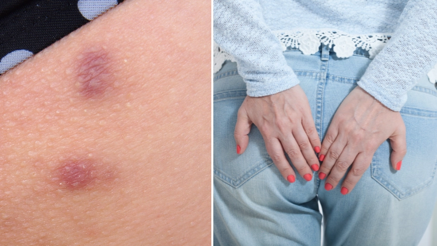 Reason you keep getting spots on your bum and how to stop it once and for all