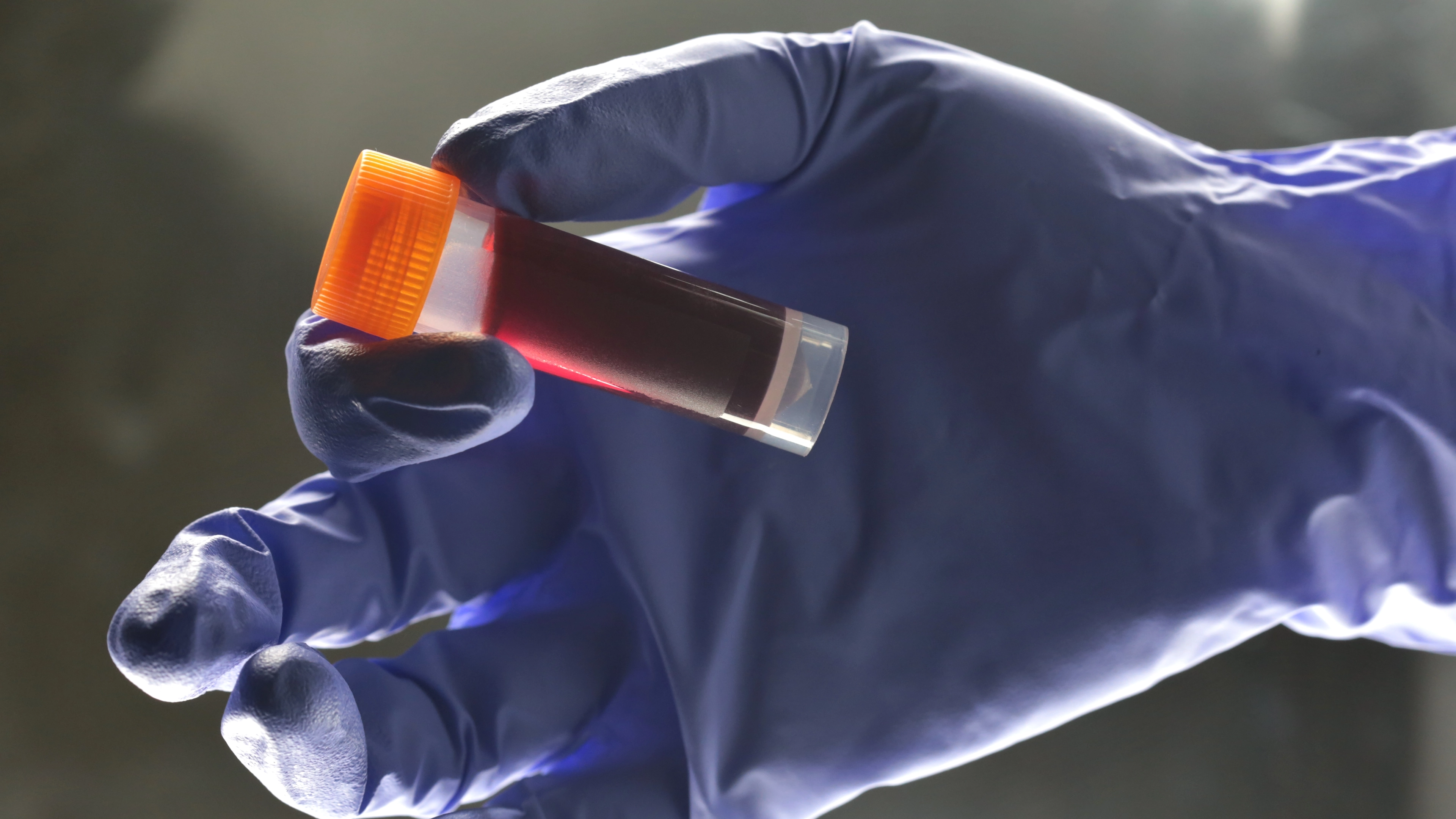 Doctors reveal the one blood type which has the lowest risk of cancer