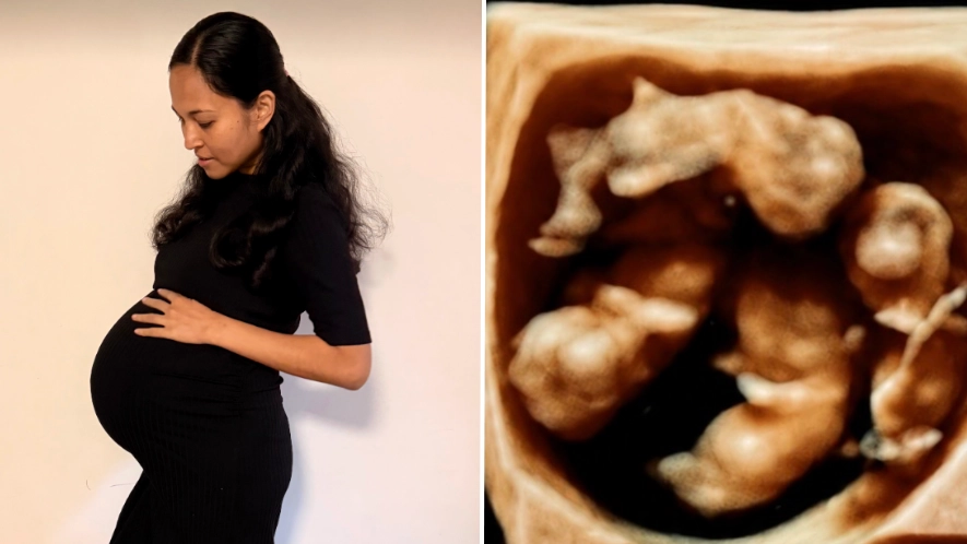 Australian mum, 34, gives birth to quadruplet babies in extremely rare way