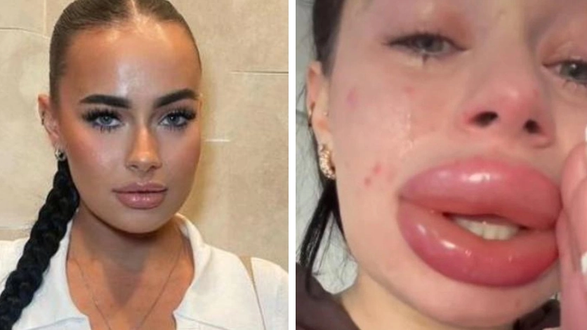 Horrified woman issues warning after free lip filler goes horribly wrong