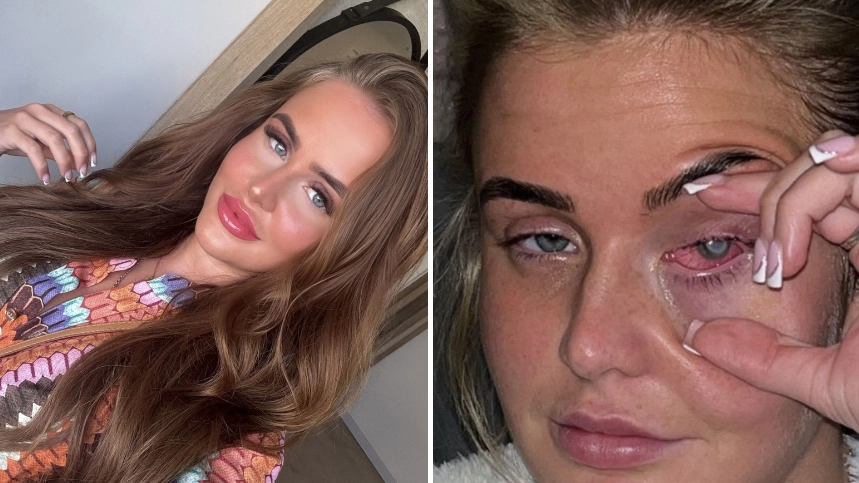 Woman left blinded for months after getting lash extensions with contact lenses in