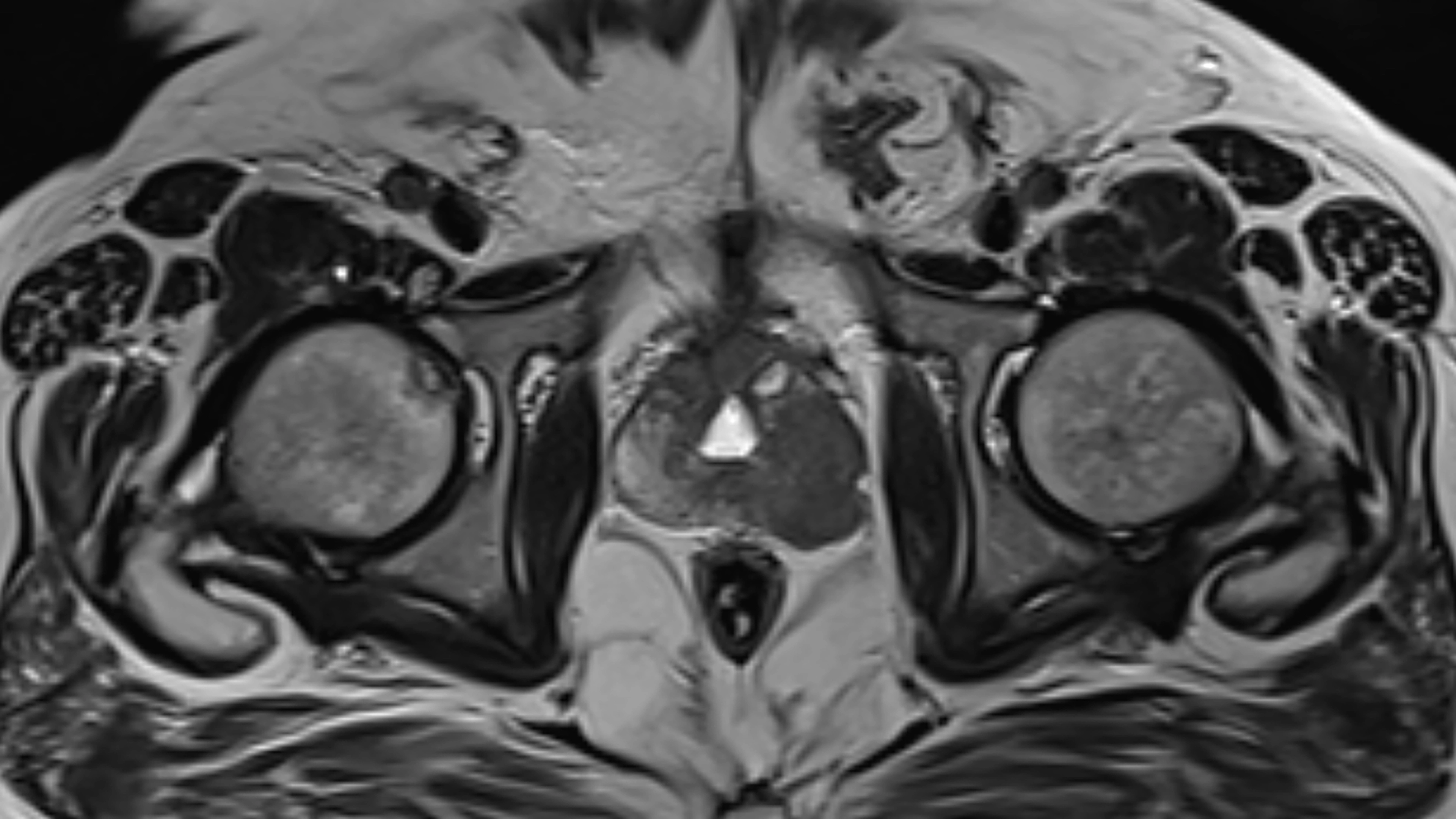 Warning signs of prostate cancer should you never ignore
