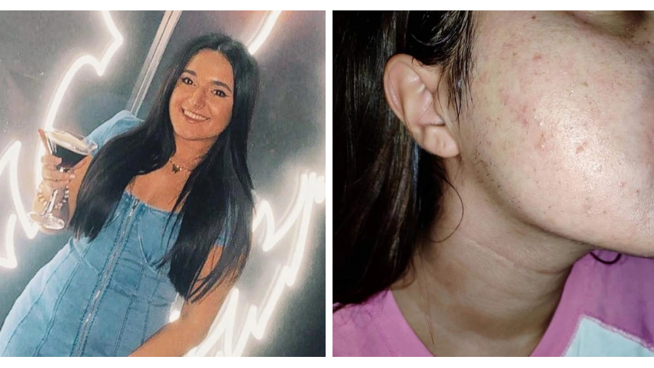 'I spent hundreds to remove excess hair after waiting seven years for a PCOS diagnosis'