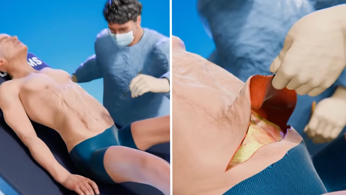 People horrified at 'unsettling' detail after realising how excess skin removal surgery actually works