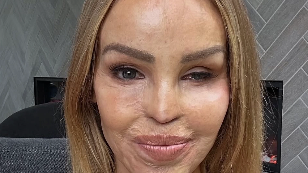 Katie Piper makes sad admission about body as she addresses ongoing health issues 17 years after acid attack