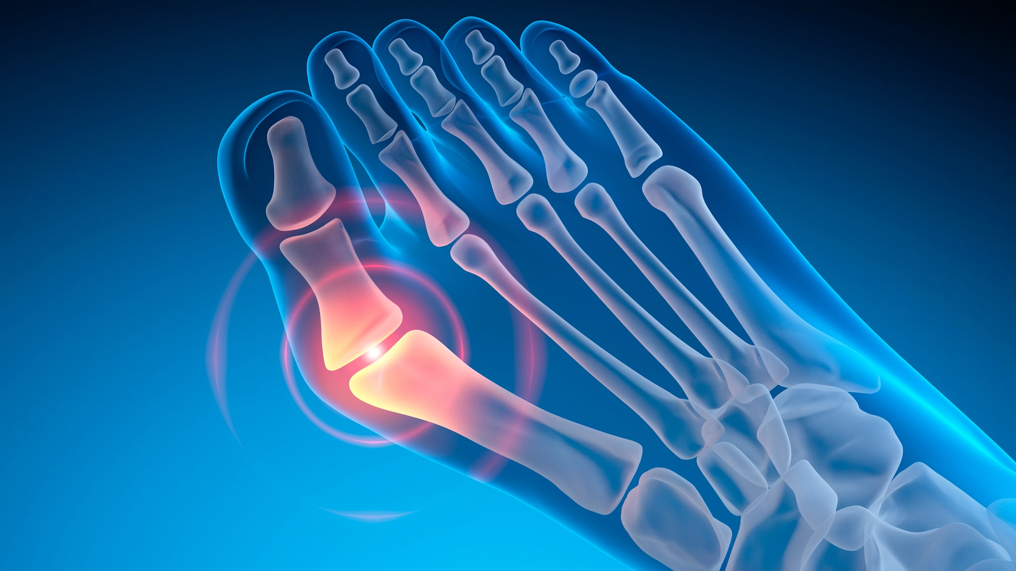 The truth behind bunions is not what you’d expect