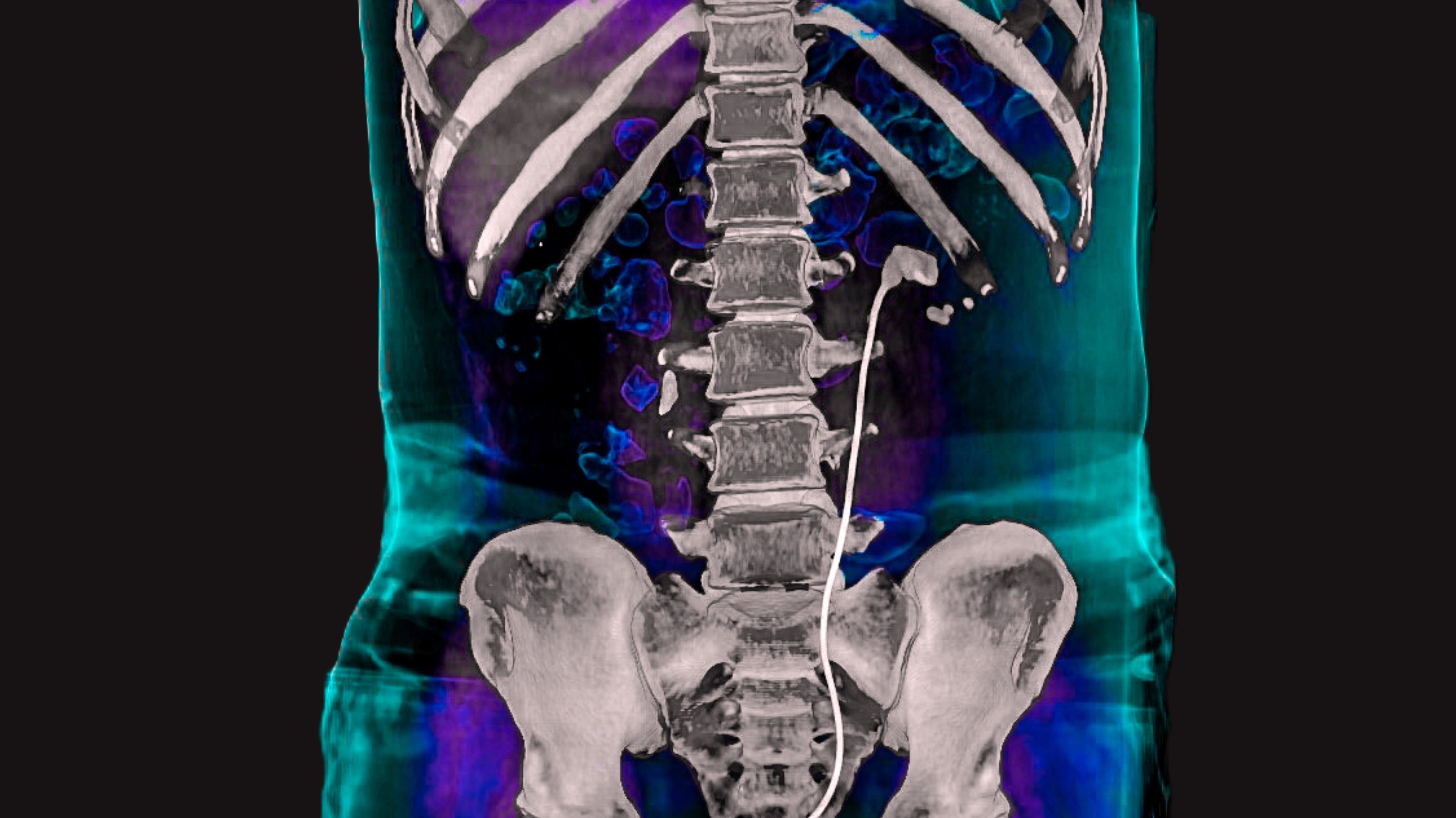 Horrifying 'scromiting' side effect of cannabis use that is 'hard to treat'