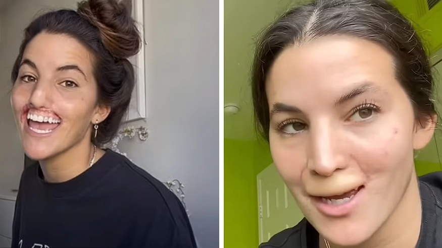 Model whose top lip was ripped off by a pit bull is now able to smile after getting multiple surgeries