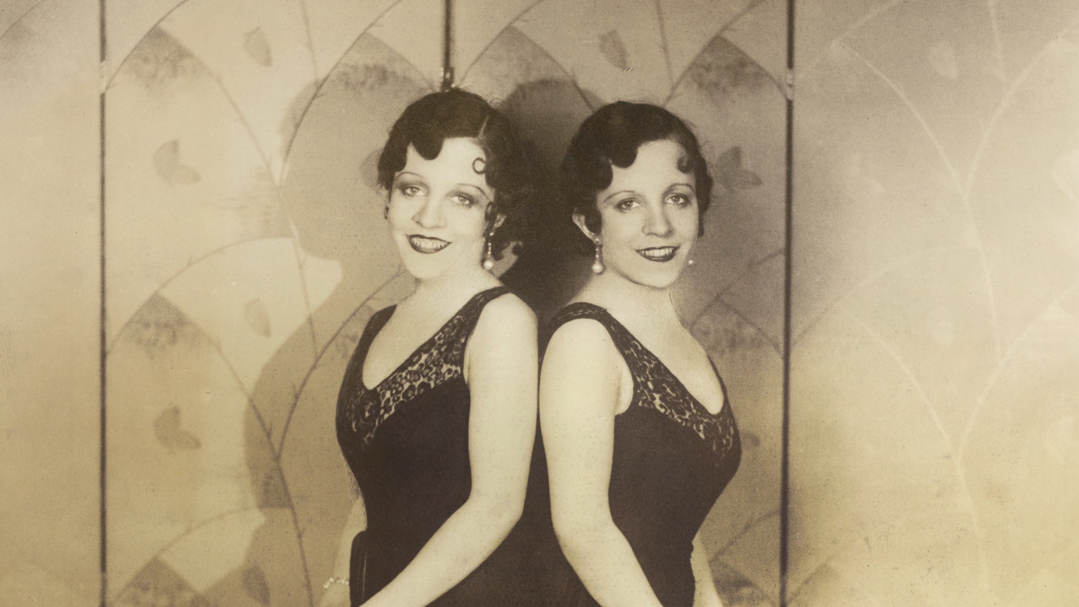Disturbing case of conjoined twin who was forced to live with dead sister attached to her