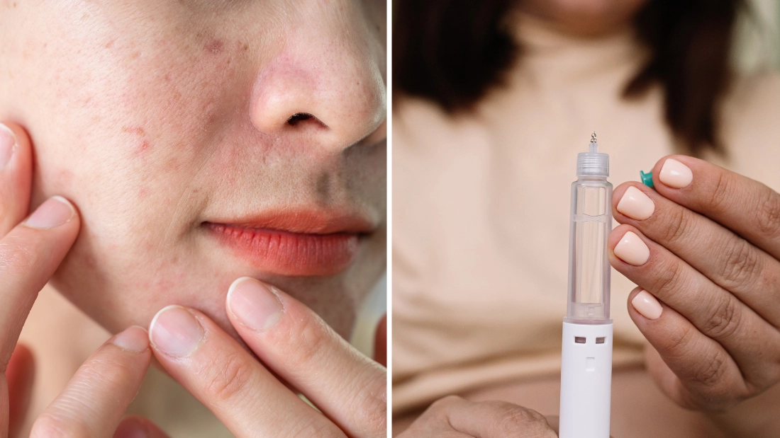 ‘Ozempic face’ explained as common side effect can cause major changes