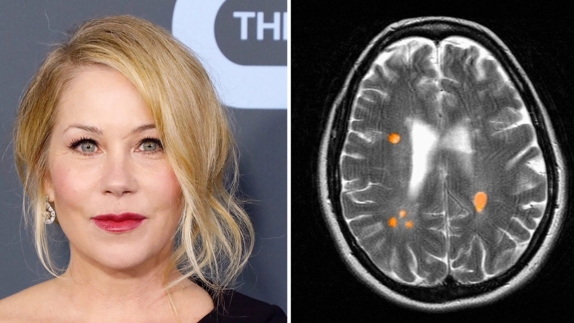 Christina Applegate missed significant MS symptom years before she got diagnosed with disease