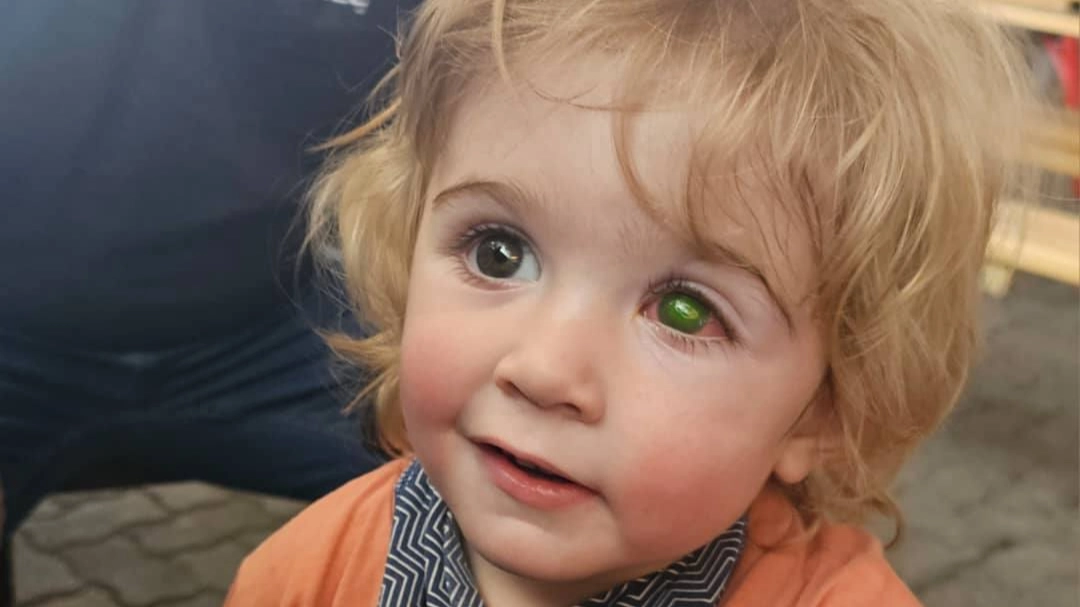 Toddler loses sight as eye turns green after being kissed by someone with herpes