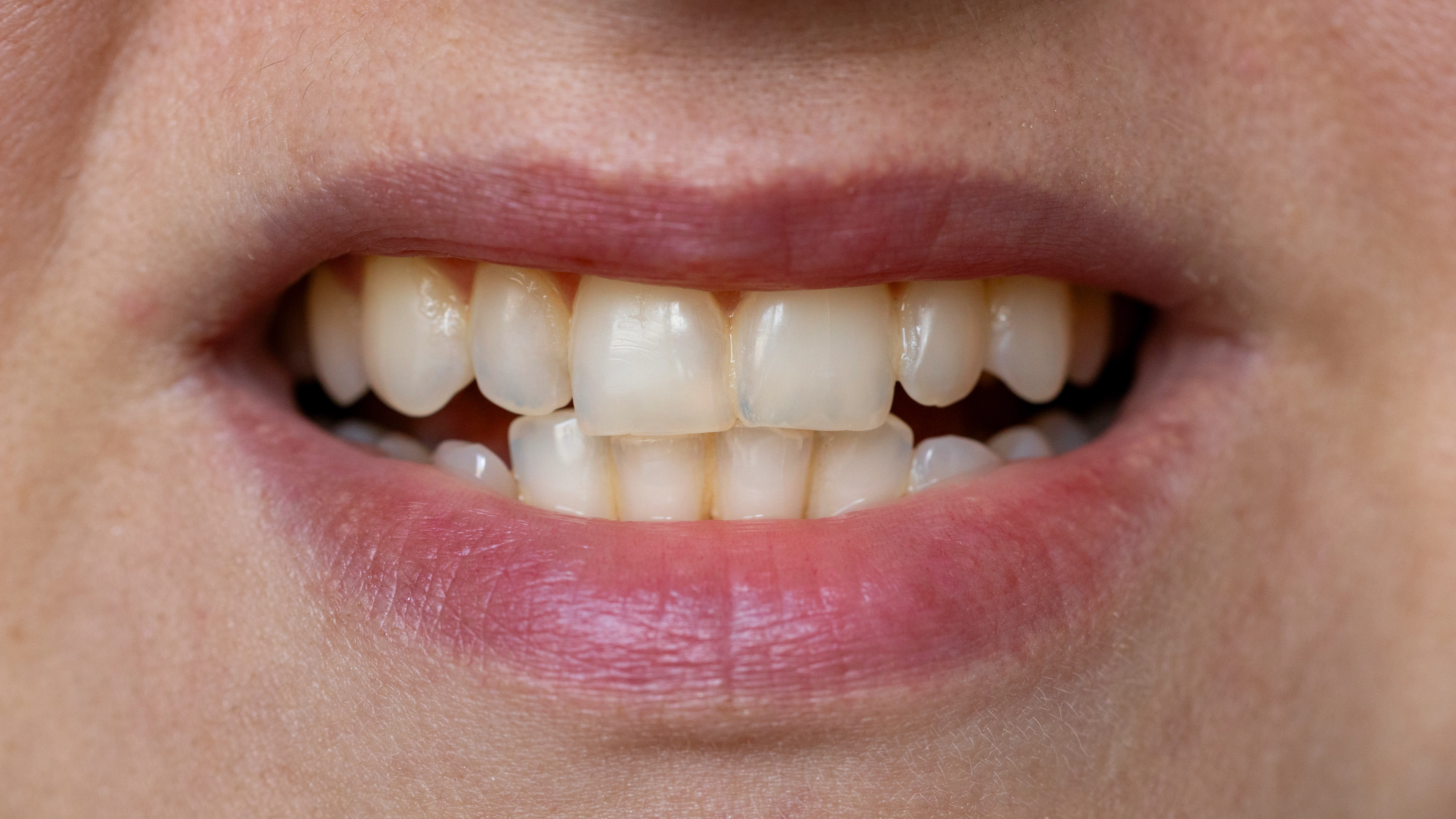 Warning issued to anyone who notices their teeth ‘going see-through’ 