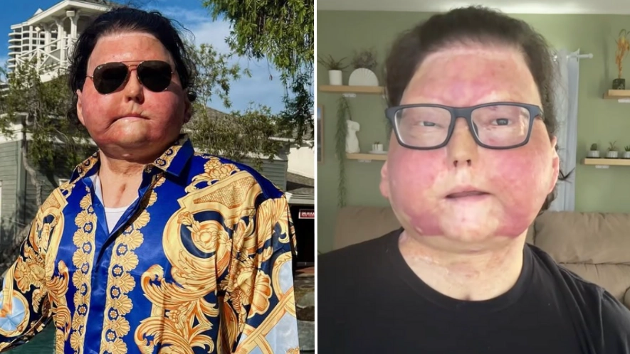 Man who received 47-year-old’s face asked unusual question about terrifying accident after waking up from three-month coma