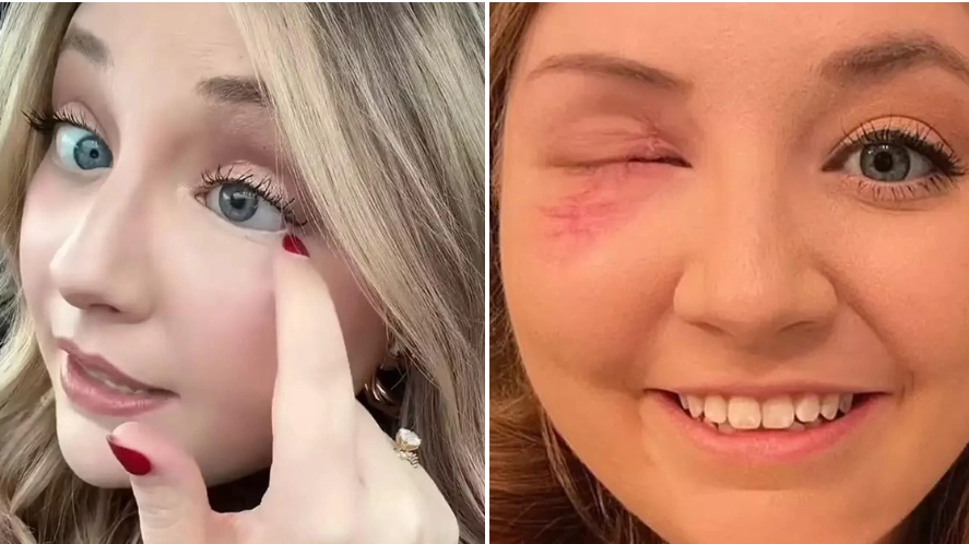 Woman issues urgent warning after she loses eye in minor car accident