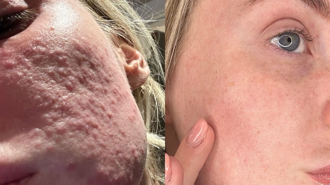Viral silver mask that ‘kills’ breakouts is hailed as ‘life-changing’