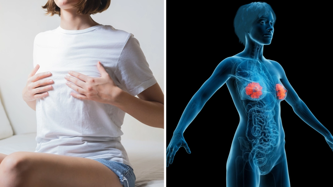 ‘Burger nipples’ explained as doctor makes important clarification for people who have them
