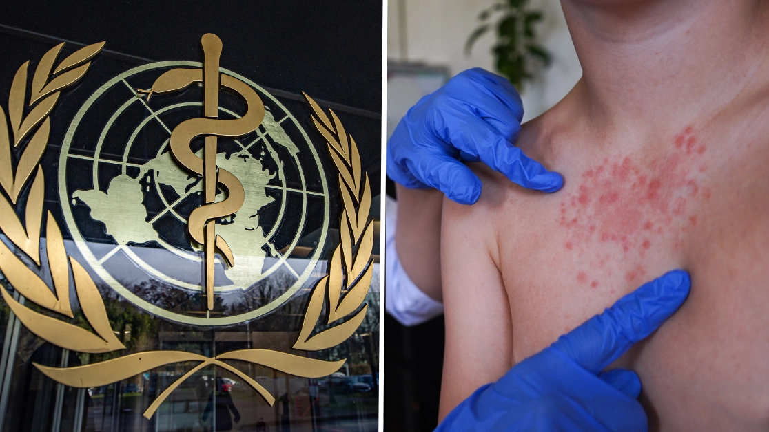 WHO issues warning as UK loses elimination status of highly contagious disease