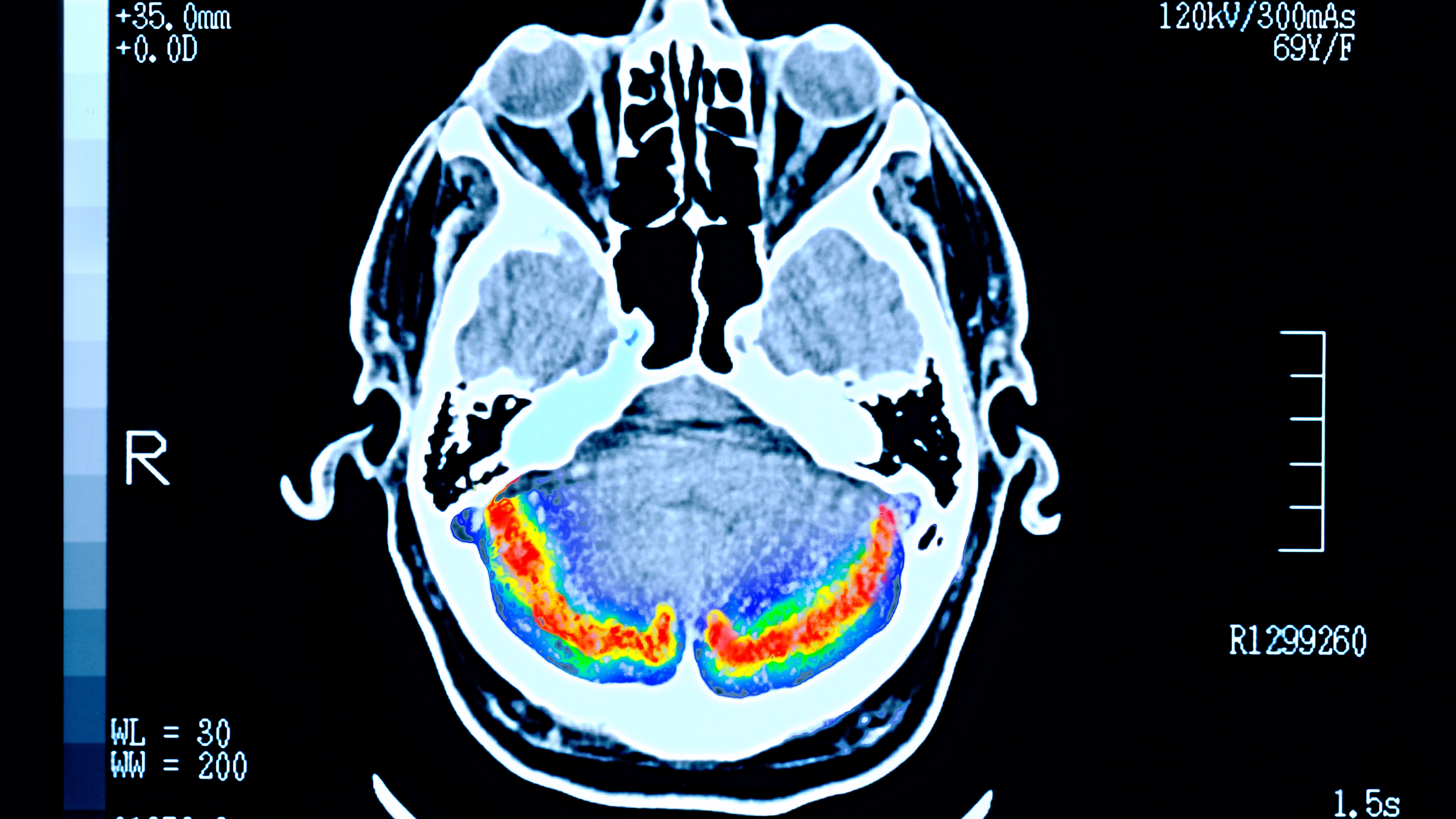 Scientists discover Alzheimer's cause could actually come from inside your mouth