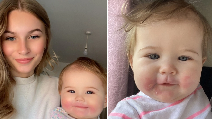 Mum claims baby left with severe burns after celery 'turned into giant hogweed'