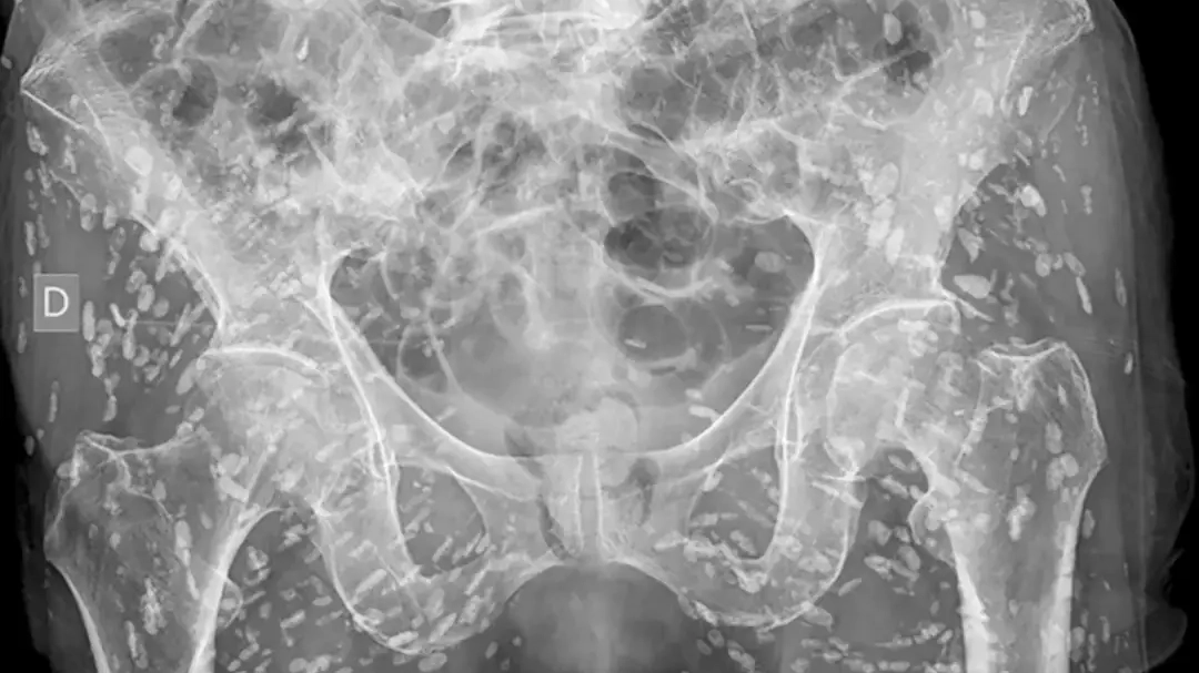 Horrific x-ray shows parasites embedded into human skin after someone made major mistake