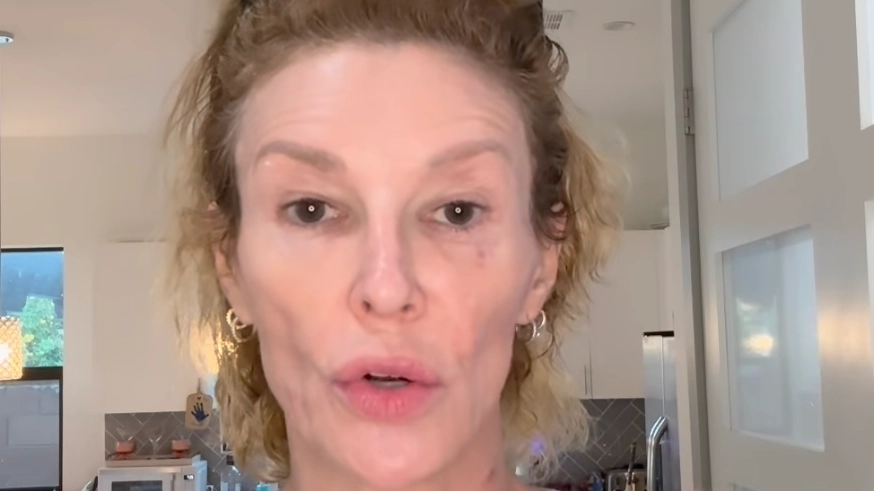 RHOBH star Brandi Glanville to have ‘face taken off’ in attempt to remove parasite