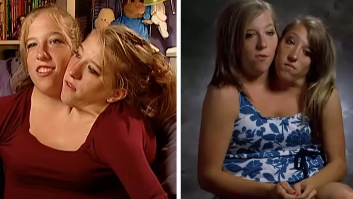 Reason why parents of conjoined twins Abby and Brittany decided not to separate them 