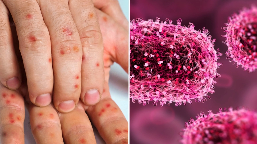 UK preparing for mpox outbreak after first case is confirmed in Europe 