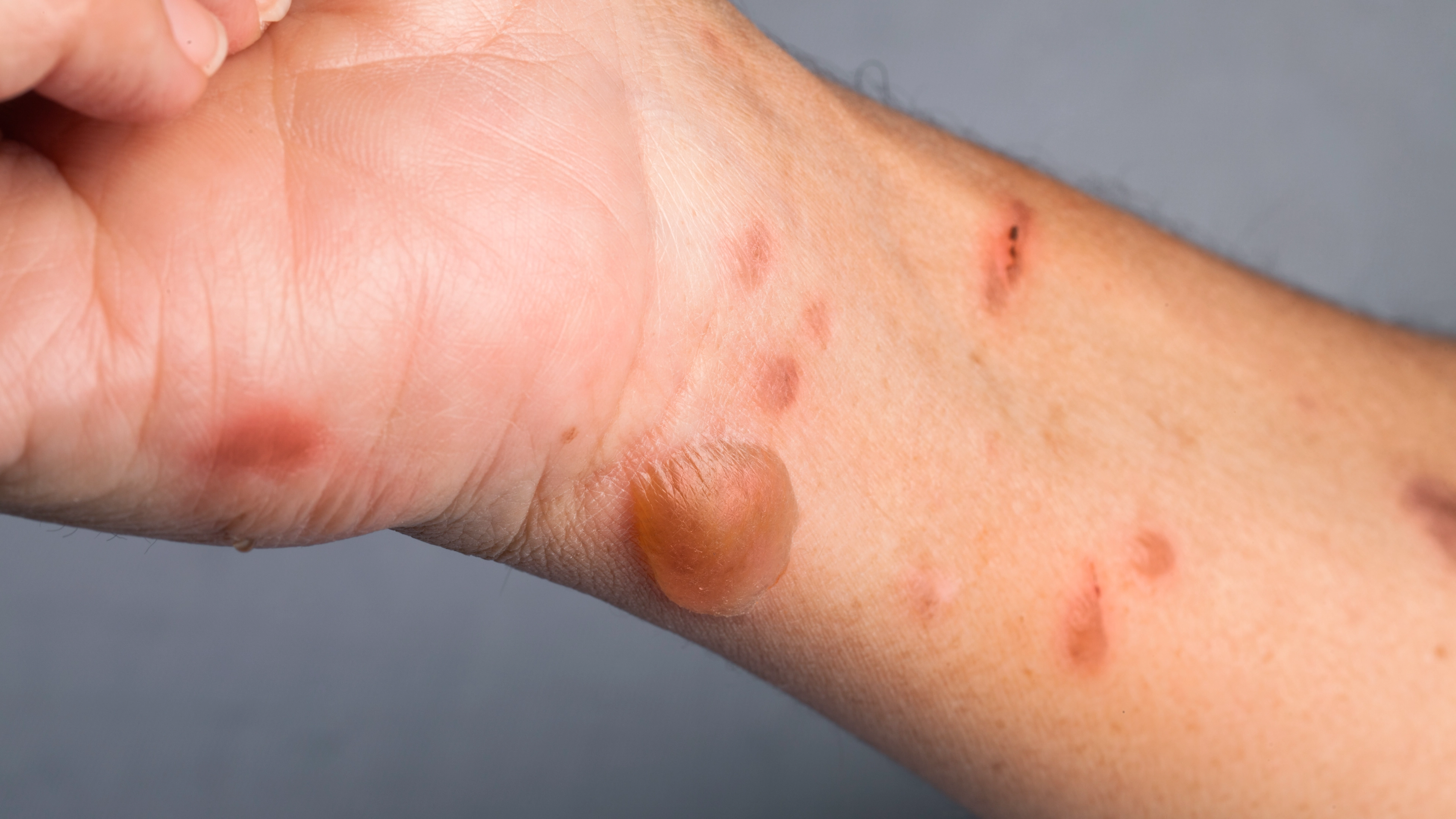 Doctors issue warning over ‘margarita burn’ as disturbing ailment could affect you this summer
