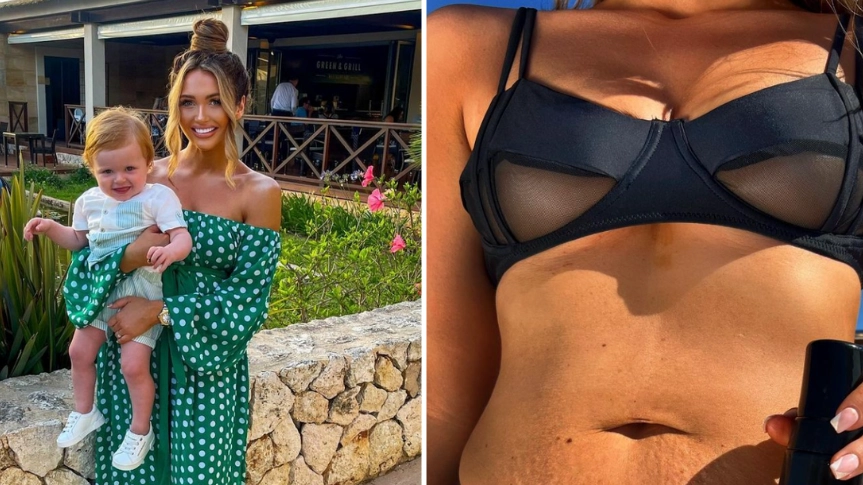 Charlotte Dawson Praised For Sharing Honest Photo Of Shaving Rash And 'Tiger Stripes'