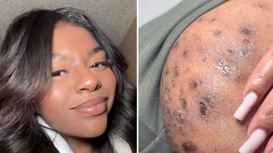 Mum speaks out on rare skin condition often mistaken for acne or ingrown hairs