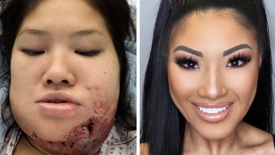 Woman who was accidentally set on fire says traumatic ordeal was 'worth everything'