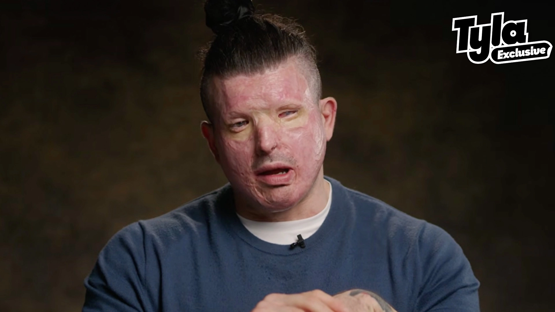 Baby's devastating reaction to seeing dad for first time after acid attack