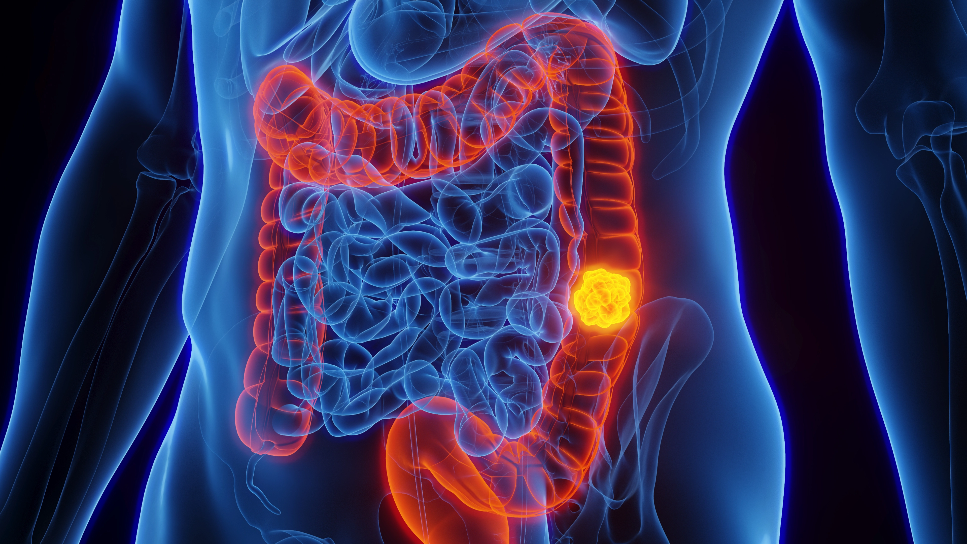 Woman with stage four colon cancer reveals five symptoms she initially dismissed