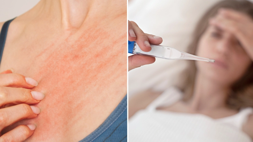 Why ‘Victorian diseases’ are on the rise as warning is issued over ‘unusually high’ rate of parasitic skin infections in the UK