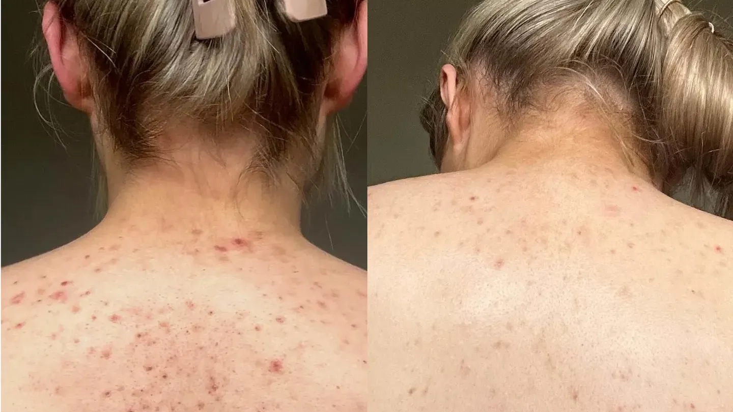 Women say body wash with surprising ingredient 'helped clear their bacne'