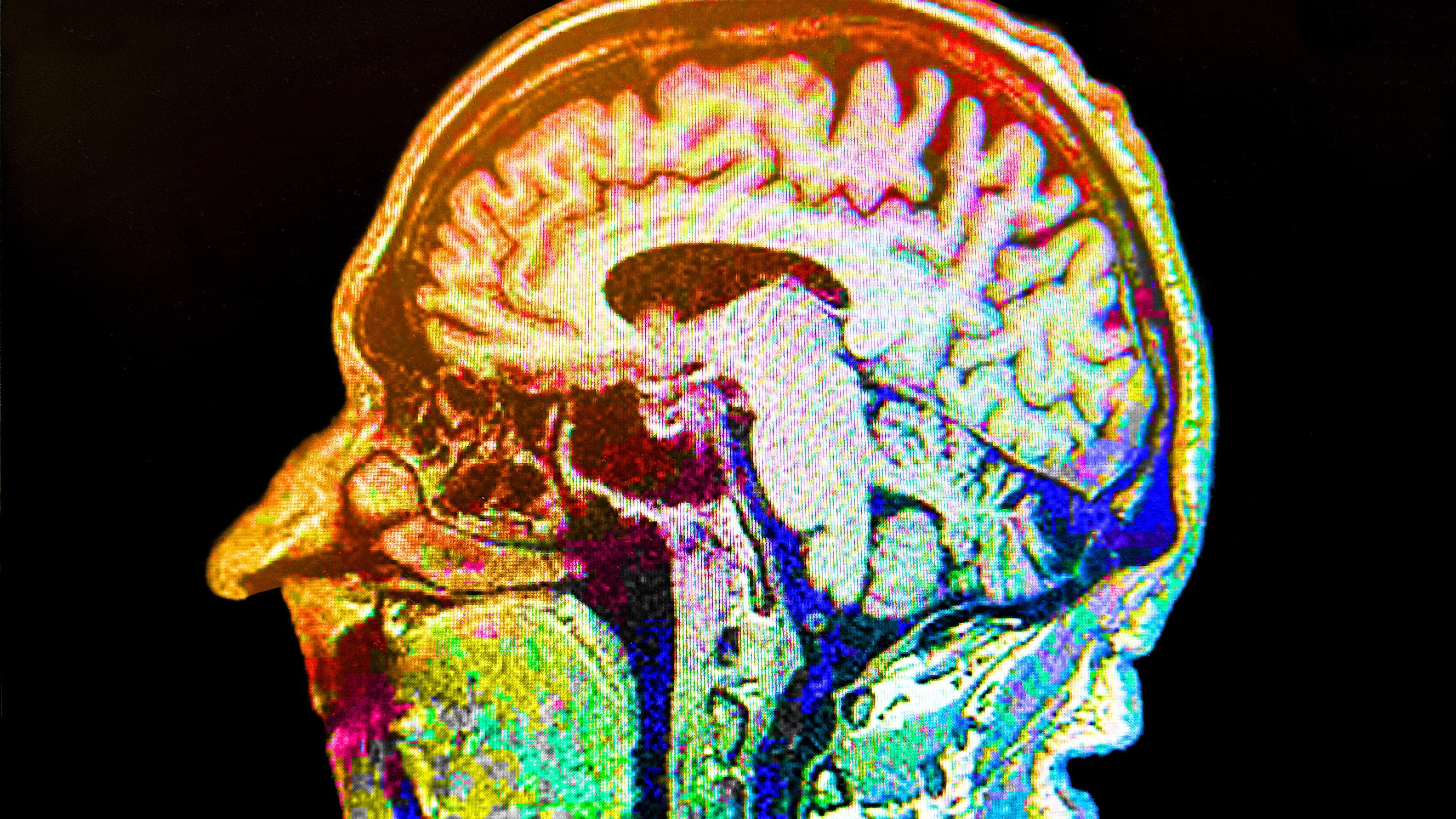 Experts reveal the most overlooked early warning signs of Alzheimer's