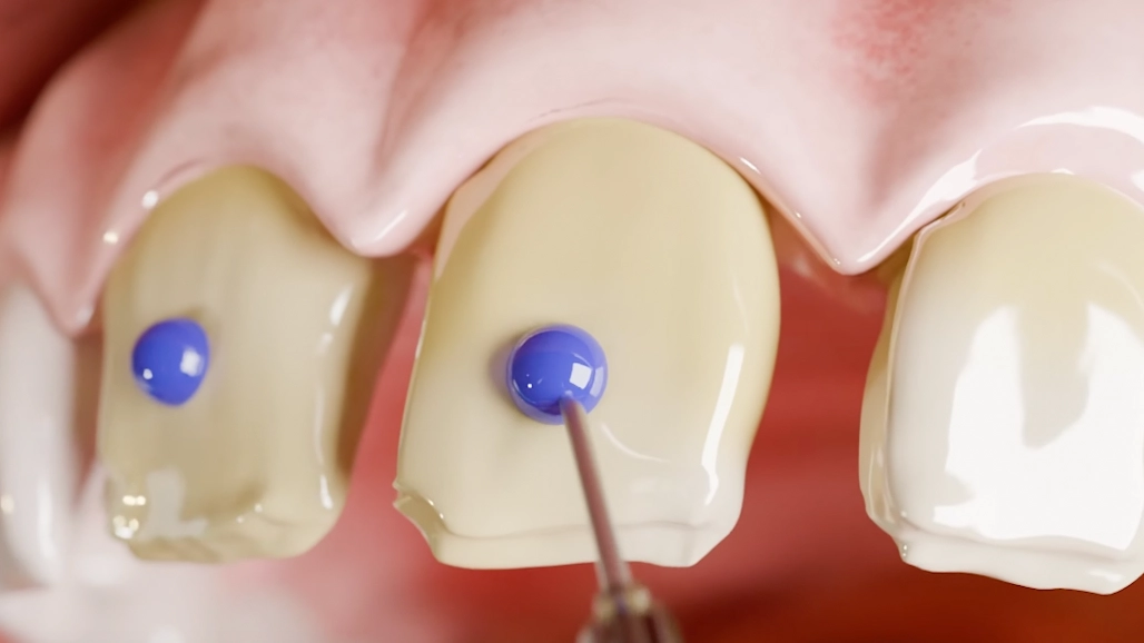 Shocking simulation shows how veneers are applied and the eye-watering cost per tooth