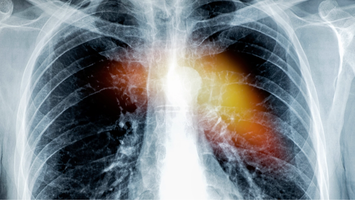 Hidden symptoms of having 'hole in heart' as thousands could have condition without even realising