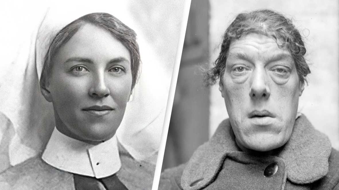 Extraordinary story of woman with two faces whose life changed permanently due to rare condition