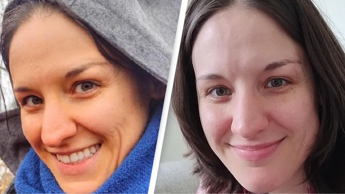 Before and after photo of woman with carotenosis reveals shocking impact of eating carrots every day
