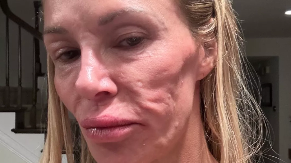 Brandi Glanville set to have 'face taken off' to 'power wash' under her skin after parasites emerge from breast implants