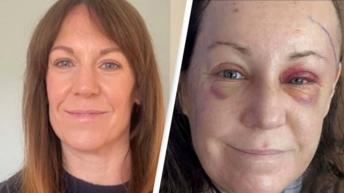Woman issues warning after routine eye test led to brain tumor diagnosis