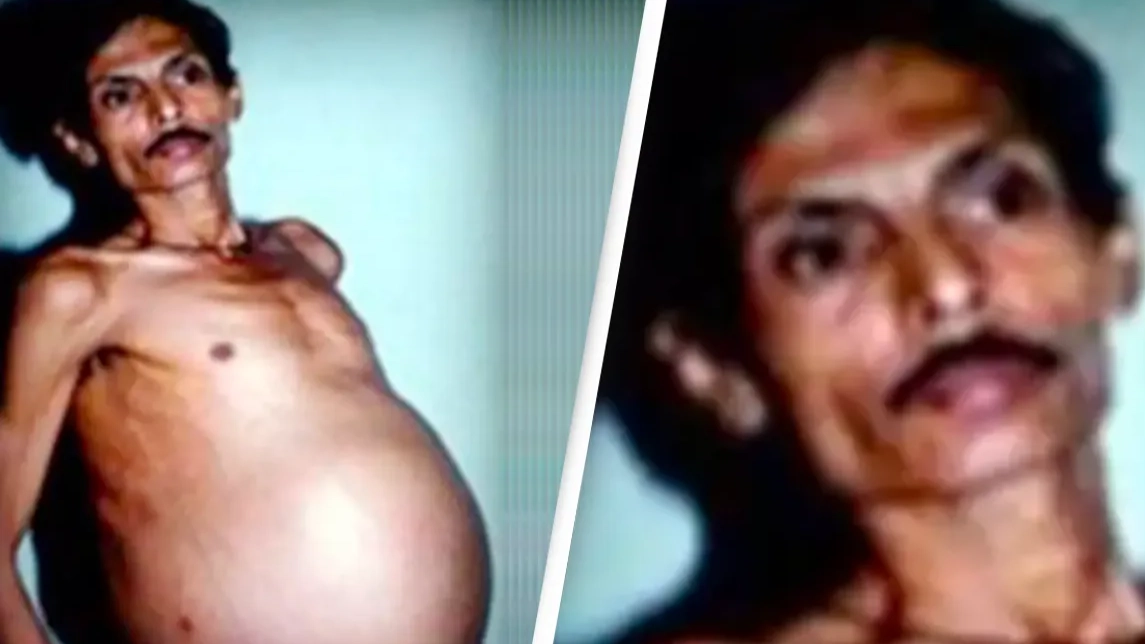 Man lived with twin inside him for 36 years without knowing