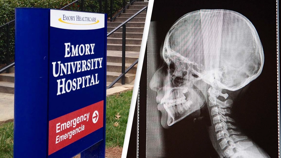 Couple sues hospital after doctors allegedly lose part of patient’s skull during surgery
