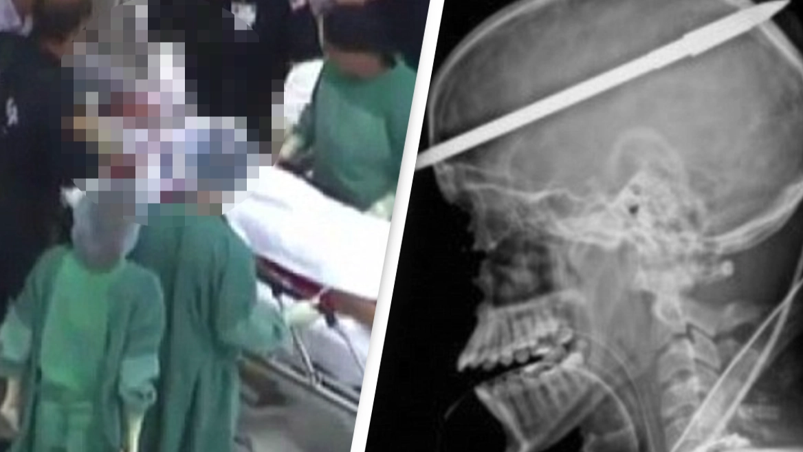 Teen who shot himself through the head with a spear gun miraculously lived to tell the tale