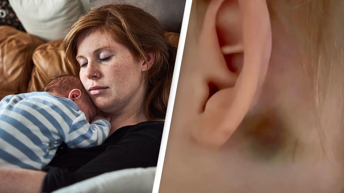 Former paramedic reveals why you should never ignore this bruise if you see it on your child
