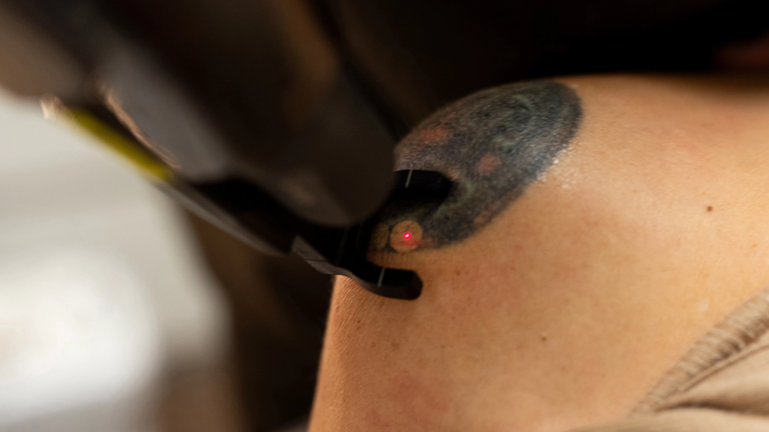 Simulation shows what actually happens to your skin during laser tattoo removal