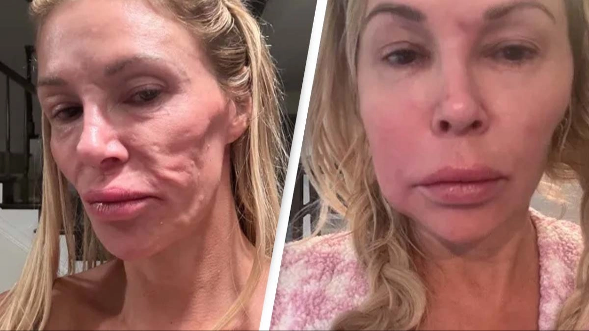 Brandi Glanville makes shocking claim on what caused her to get facial 'parasite' as it made her 'lose everything'